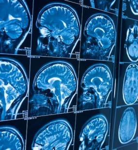 MRI scan of brain